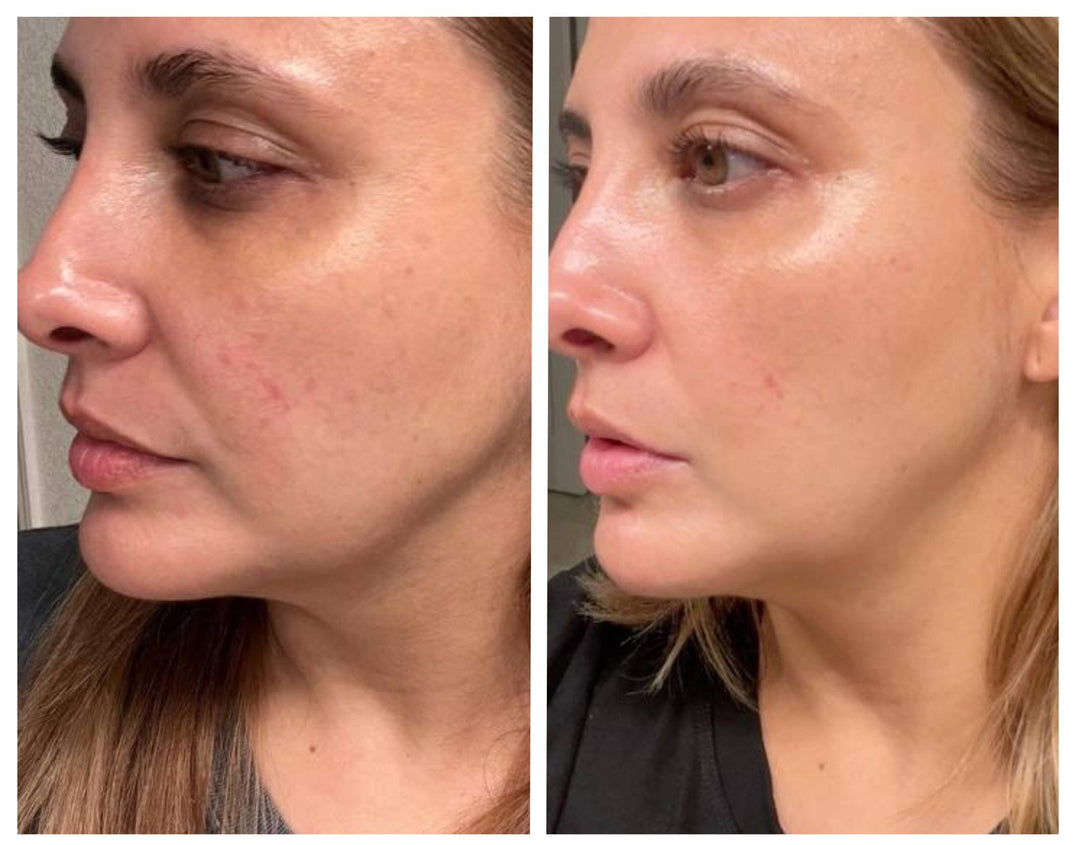 🇺🇸 Say Goodbye to Clogged Pores! | 🇲🇽 ¡Dile Adiós a los Poros Obstruidos!